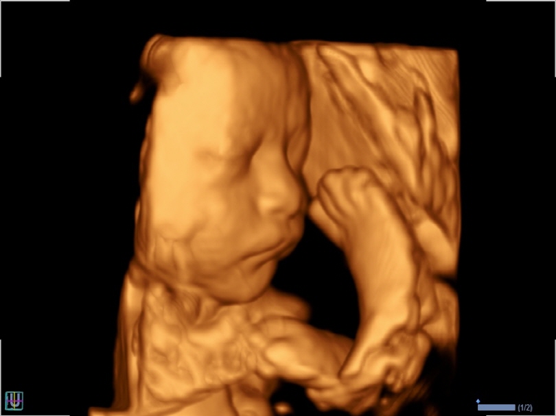 Fetal Face in 3D Mode1