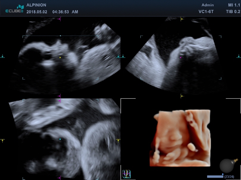 Fetal Face in 3D MPR Mode with Live HQ™1