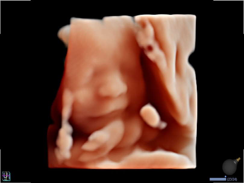 Fetal Face in Live HQ™(1)1