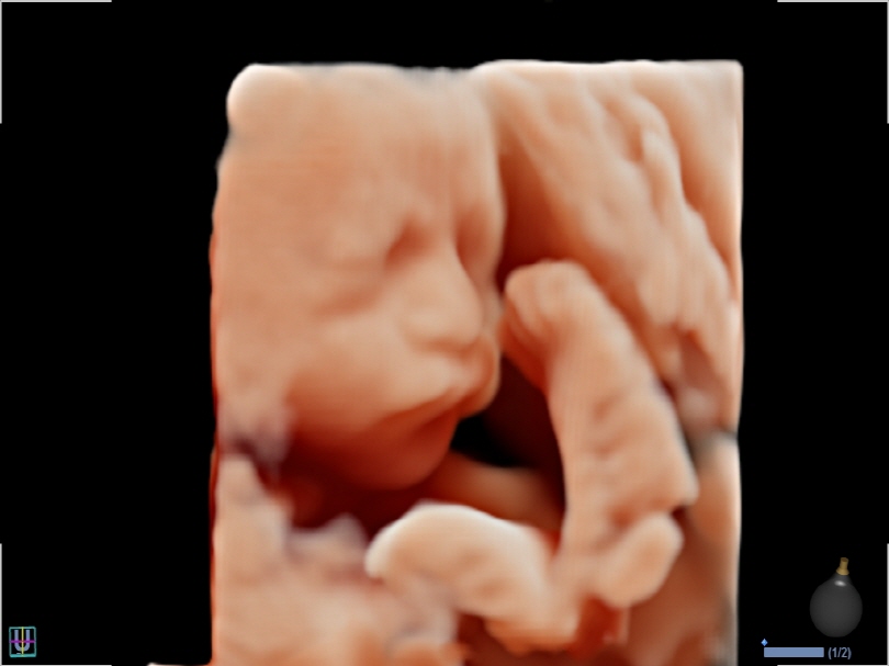 Fetal Face in Live HQ™(3)1
