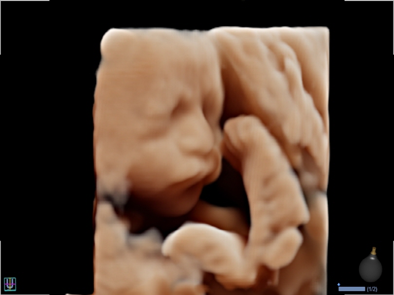 Fetal Face in Live HQ™(4)1