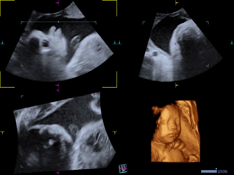 Fetal Face in MPR Mode1