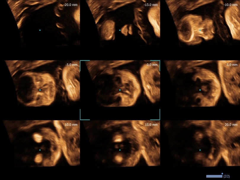 Fetal Face in Multi Slice View of Volume Master™1
