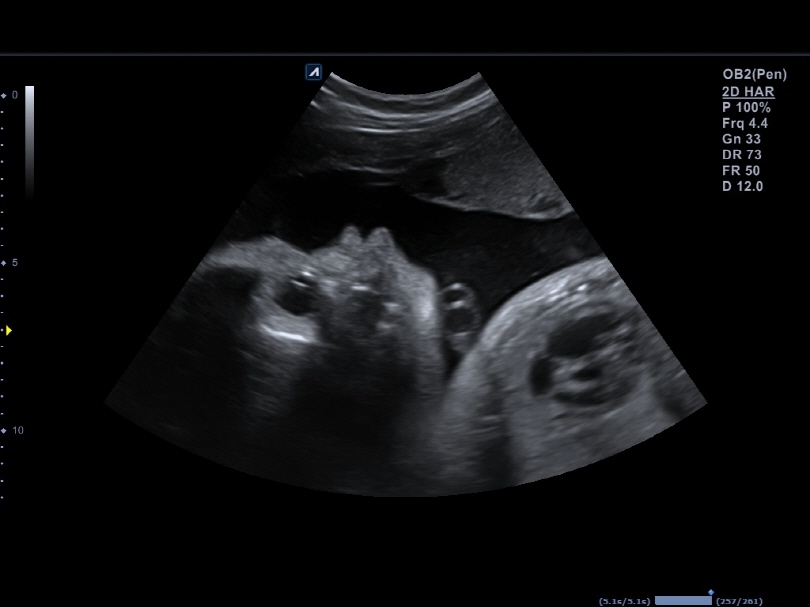 Fetal Profile View in 2D Mode1