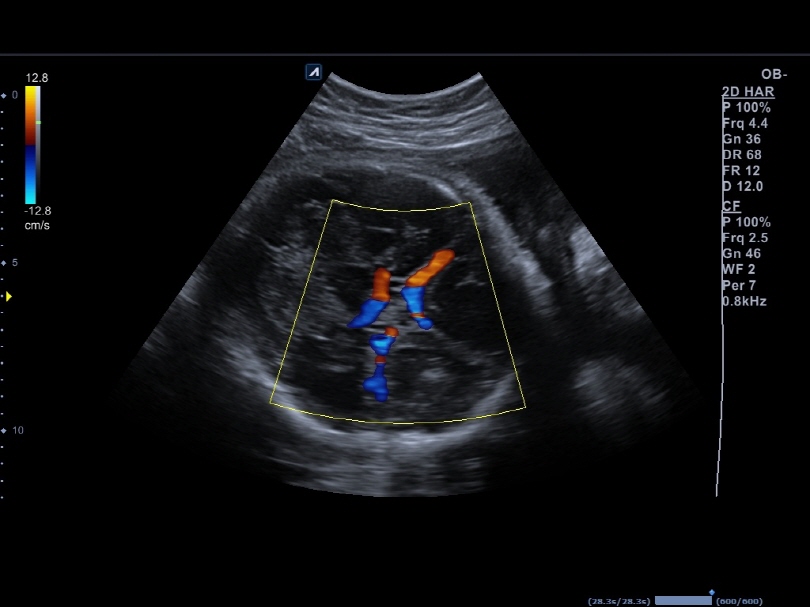 Middle Cerebral Artery in Color Flow Mode1