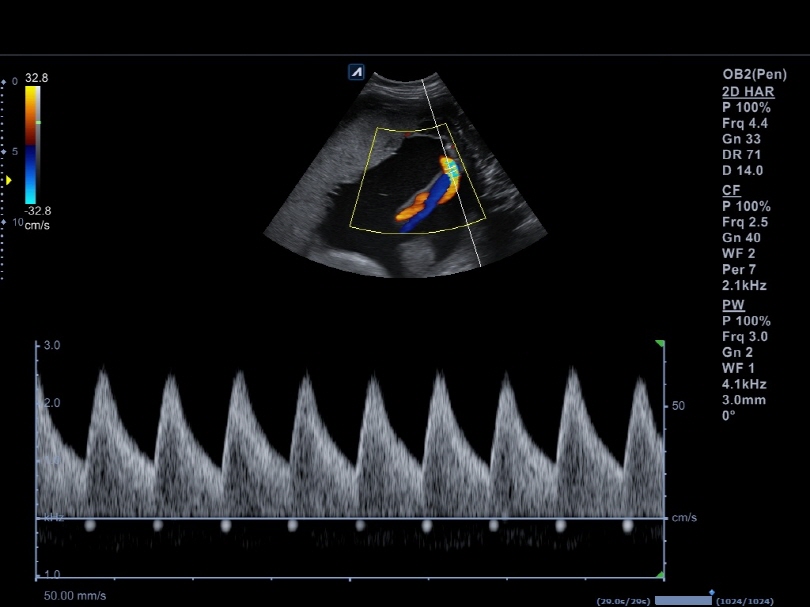 Umbilical Artery in PW Mode1
