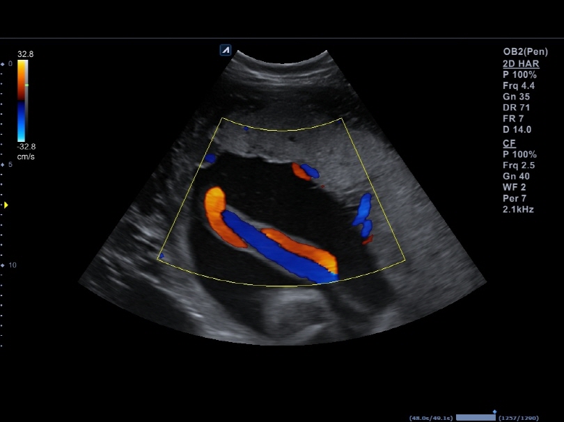 Umbilical Cord in Color Flow(1)1