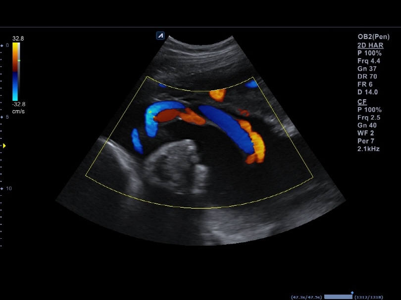 Umbilical Cord in Color Flow(2)1