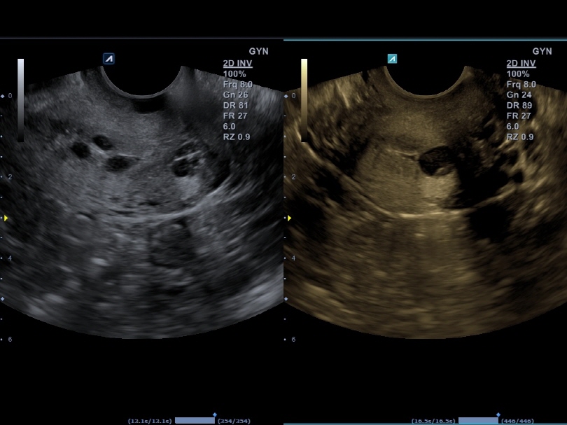 Uterine Cervix in Dual Mode1