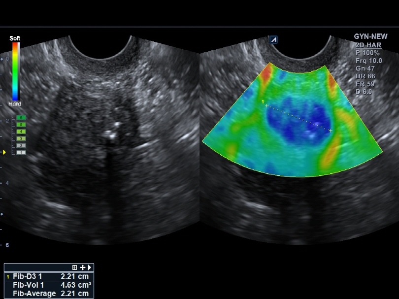 Uterine Fibroid in Elastography1