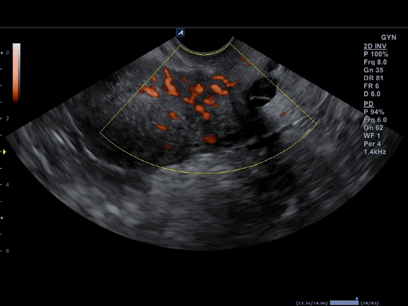 Uterus in Power Doppler Mode1