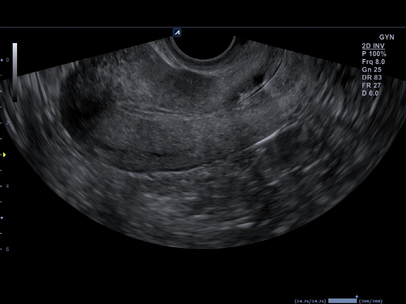 Uterus Saggital View in 2D Mode1