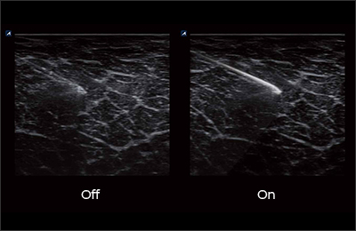 Needle Vision™ Plus