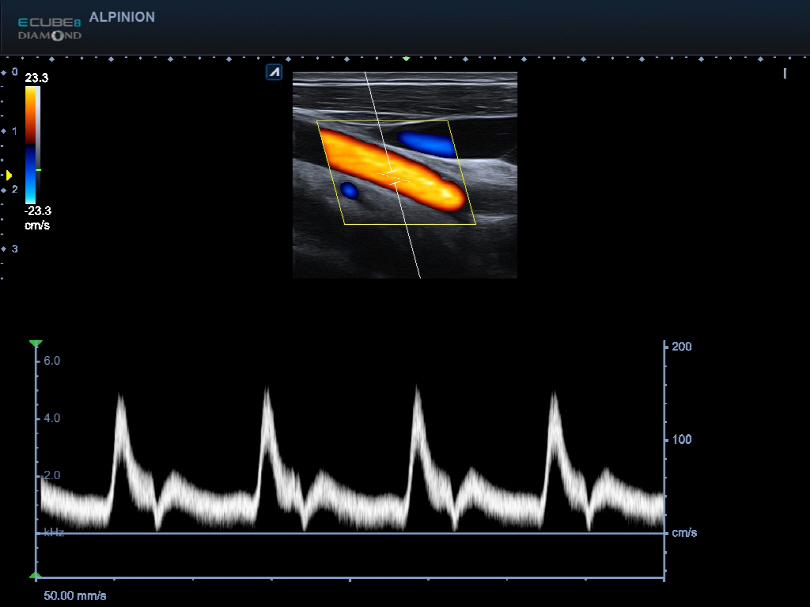 Carotid in PW Mode
