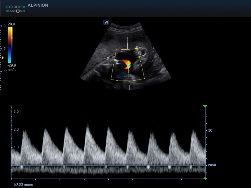 Umbilical Cord in PW (Xpeed_after)