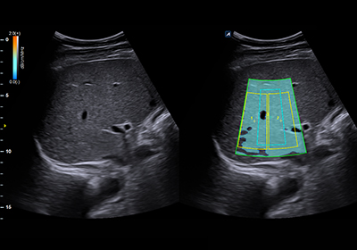 ATI (Imágenes por Atenuación del Tejido)