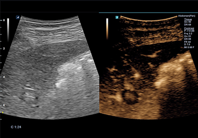 CEUS(Contrast Enhancement Ultrasound)