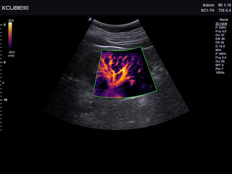 Gallbladder in 2D mode