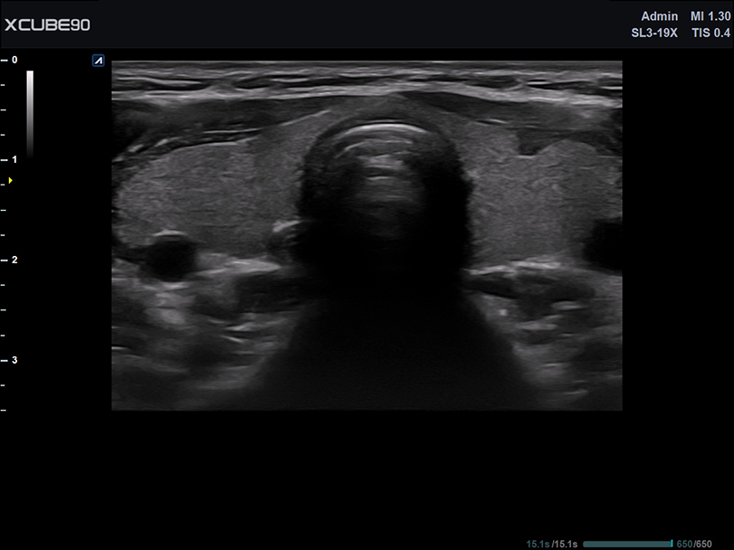 Thyroid nodule in CF mode