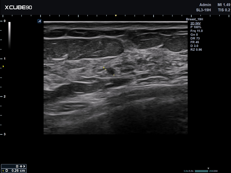 Breast nodule in 2D mode