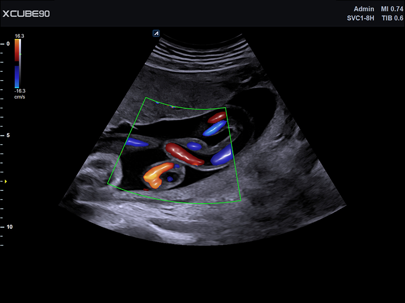 Fetus face at 20  week in 2D mode