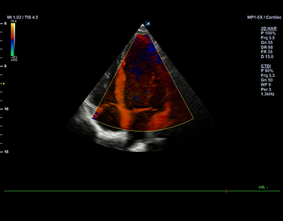 Tissue Doppler Imaging