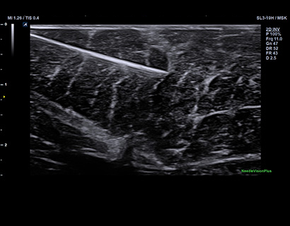 Needle VisionTM Plus