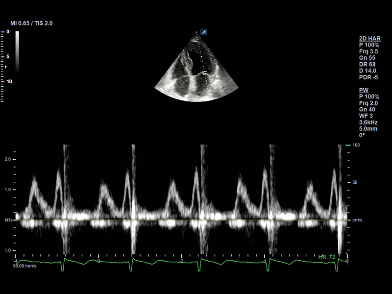 Apical view_4 chamber_PW_Mitral valve_Diastolic function_Mild Dysfunction