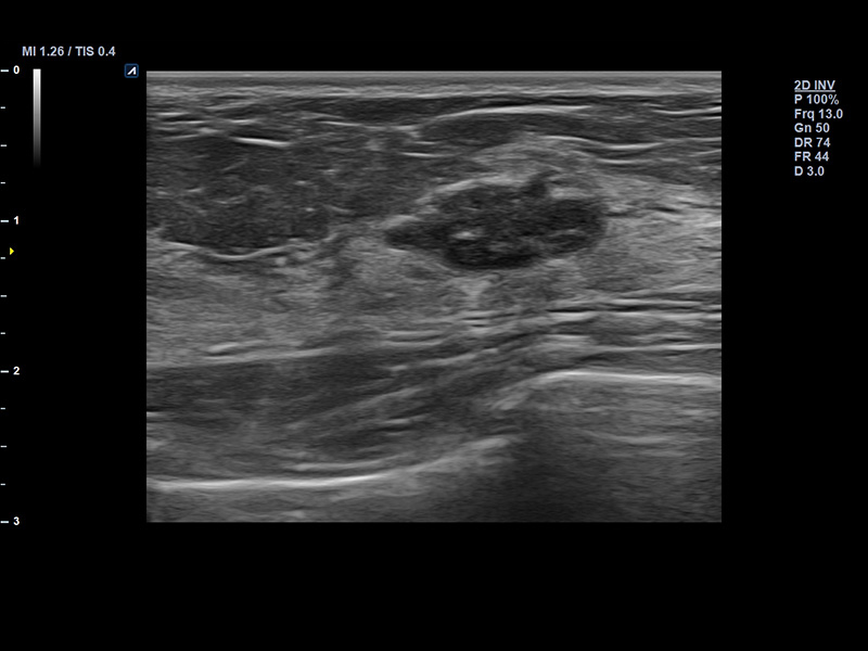 Breast_2D_Fibroadenoma