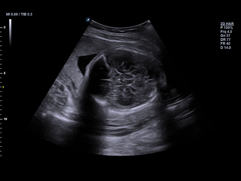 Fetal brain_2D_Normal case