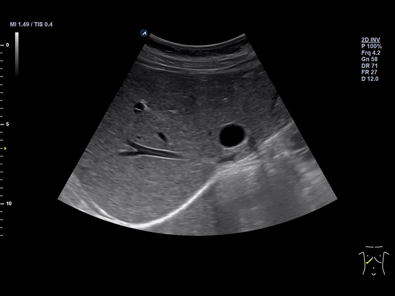 Liver_2D_Liver cyst(Hepatic cyst)