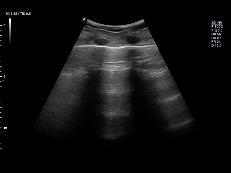 Lung A-line _2D_Normal case