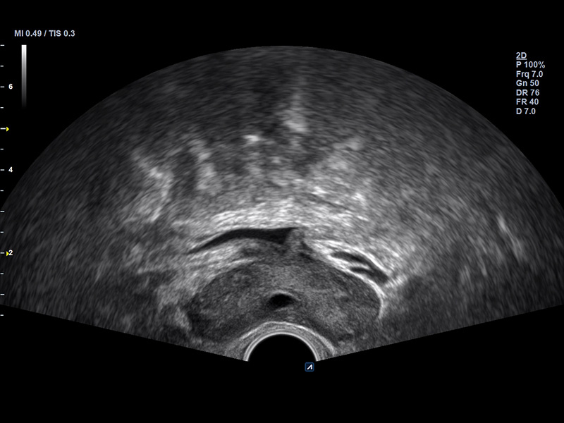 Prostate_2D_Normal case