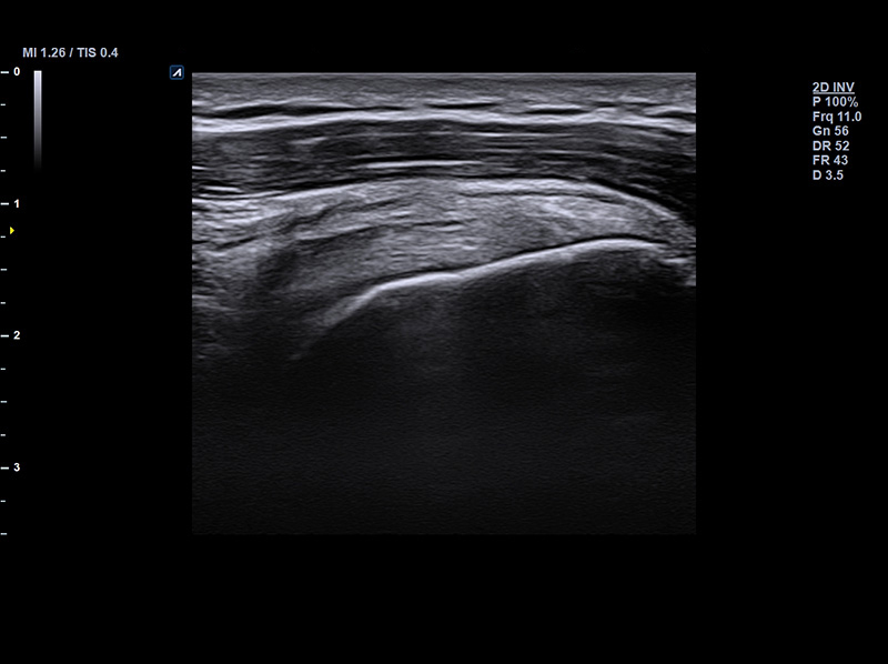 Shoulder supraspinatus _2D