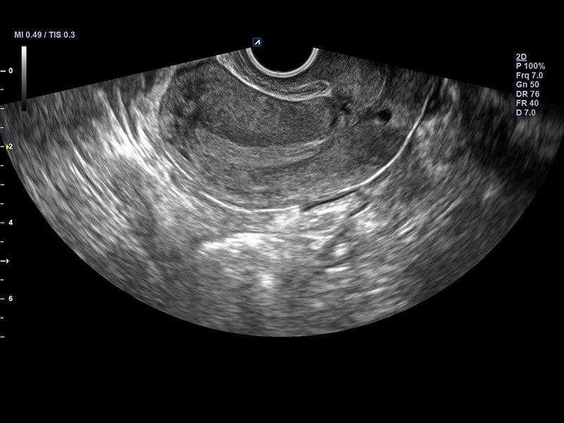 Uterus_Longitudinal view_2D_Normal pelvic ultrasound